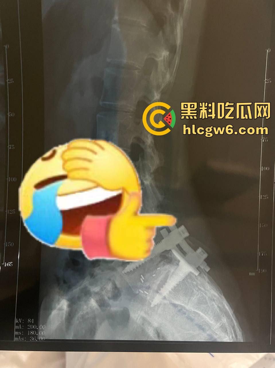 厦门大学嘉庚学院爆发校园霸凌事件!大四学姐被殴打险瘫痪,学校深夜删帖惹怒学生,游行群组已悄然建立!-6