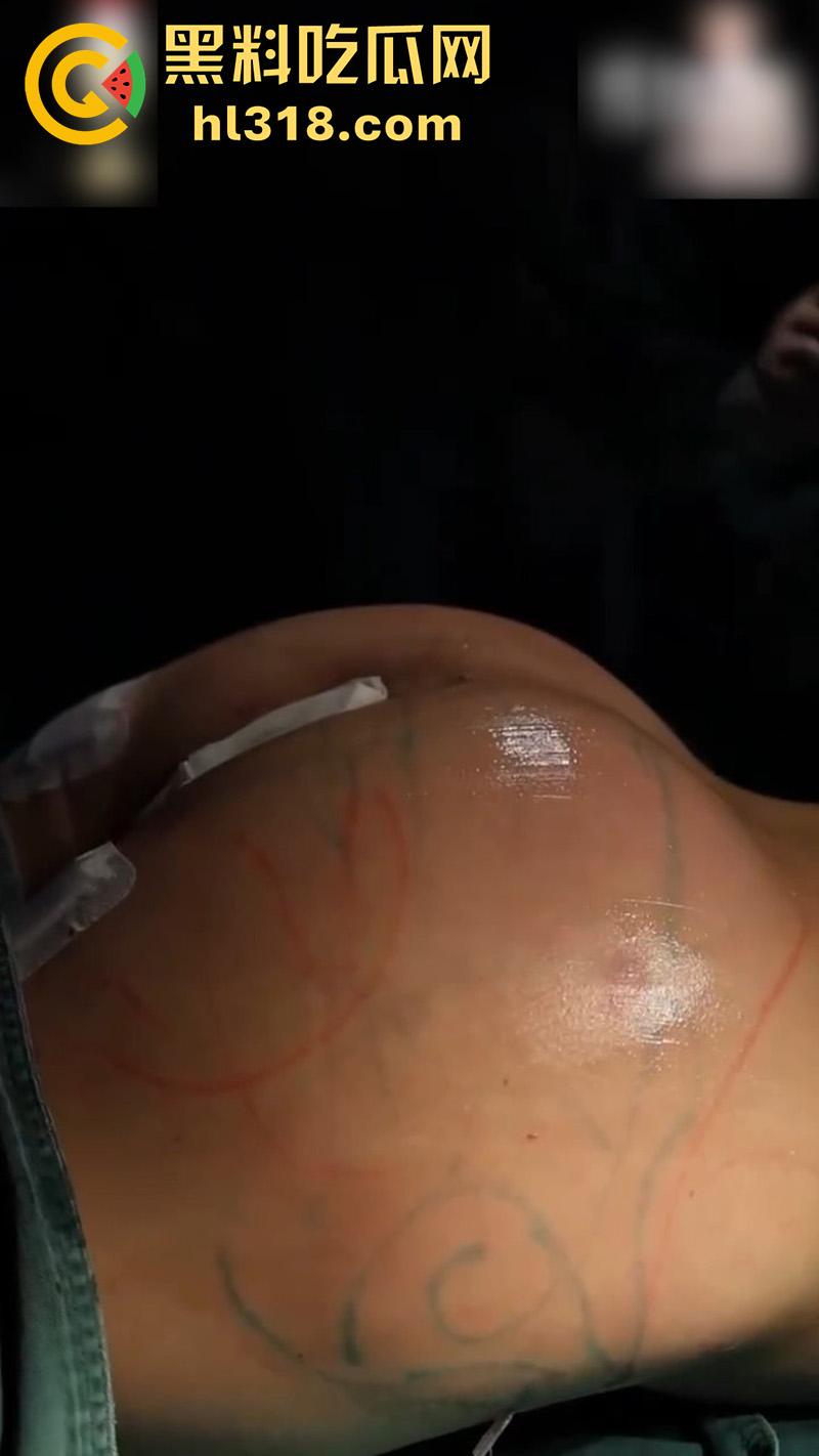 实拍整形医院手术现场，小仙女为了变美，抽脂和填充全过程，虽然看着残忍，但做完后的确是好看呢！-2