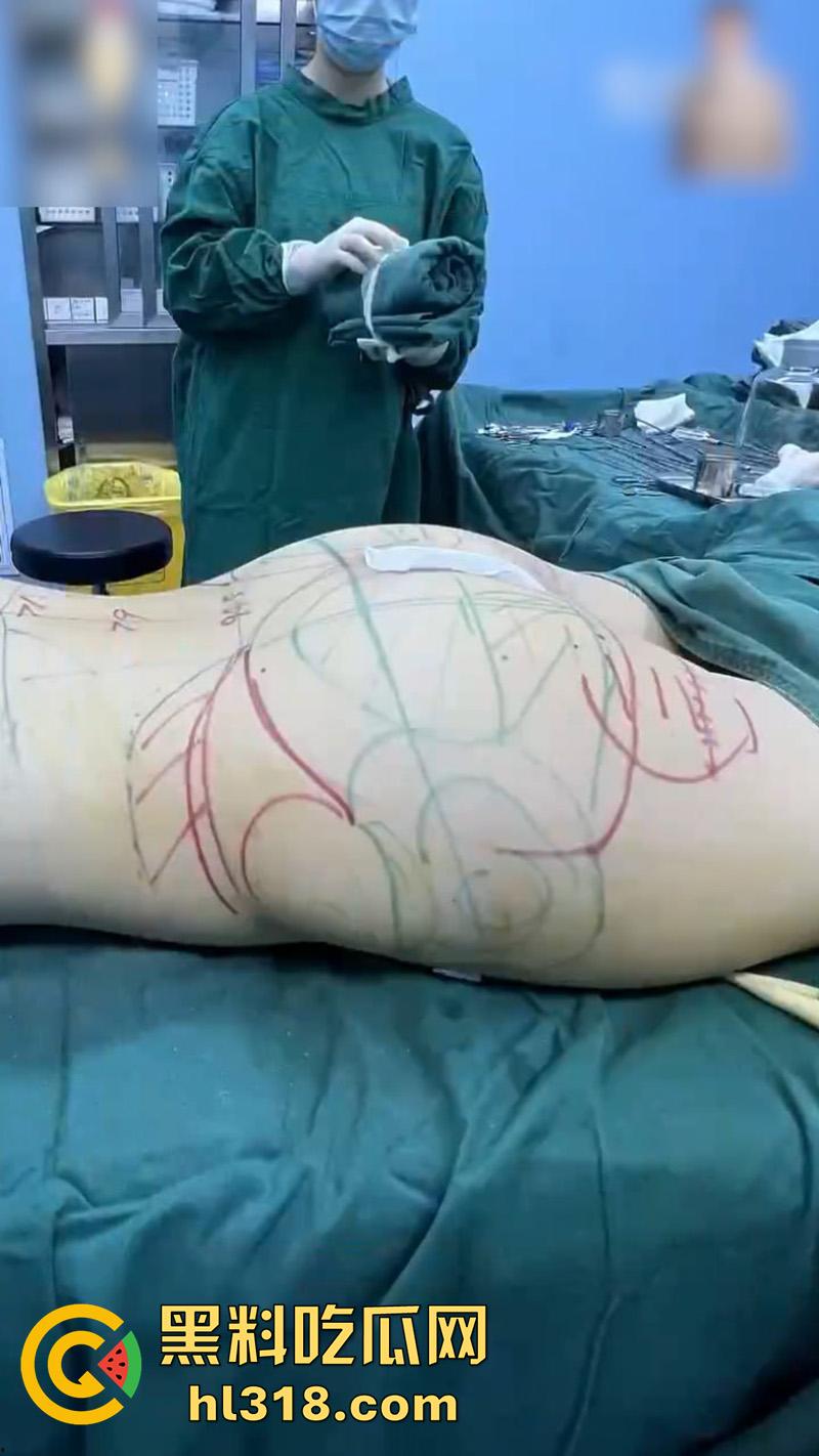 实拍整形医院手术现场，小仙女为了变美，抽脂和填充全过程，虽然看着残忍，但做完后的确是好看呢！-4