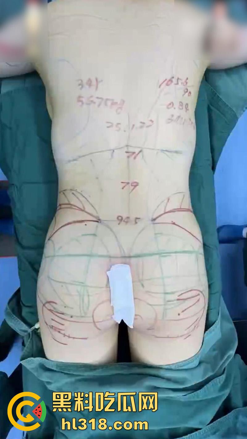 实拍整形医院手术现场，小仙女为了变美，抽脂和填充全过程，虽然看着残忍，但做完后的确是好看呢！-6