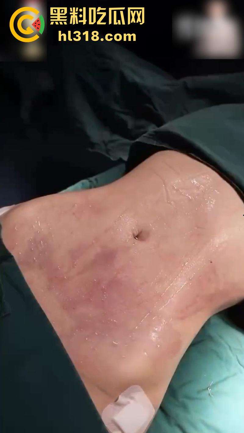 实拍整形医院手术现场，小仙女为了变美，抽脂和填充全过程，虽然看着残忍，但做完后的确是好看呢！-10