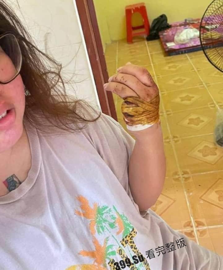 中国女孩王某被人诱骗到柬埔寨 后遭越南人绑架 被切掉一根 手指，并拍摄下视频威胁其国内家人勒索500万-6