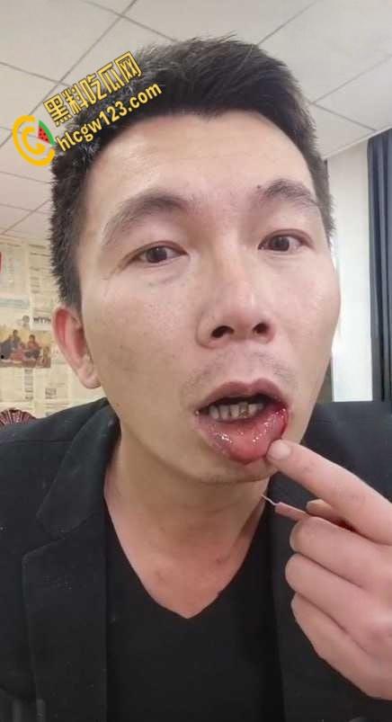 抖音狠人博流量 , 鞭炮嘴炸出血,脑残操作震惊全网 !-8