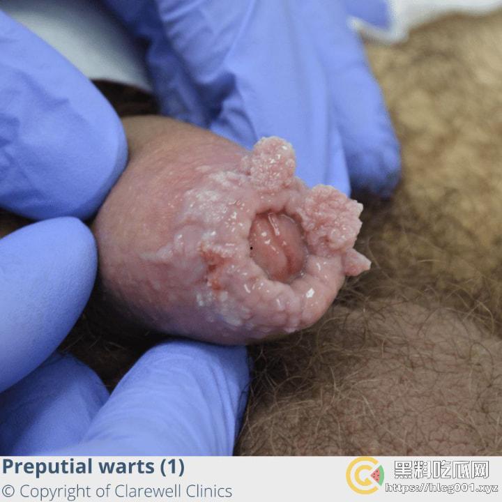 性病篇  谨慎观看！瓜友们出门在外 一定得洁身自爱 世界上没有后悔药  安全第一！！！ （二）-13