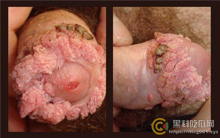 性病篇  谨慎观看！瓜友们出门在外 一定得洁身自爱 世界上没有后悔药  安全第一！！！ （二）-17