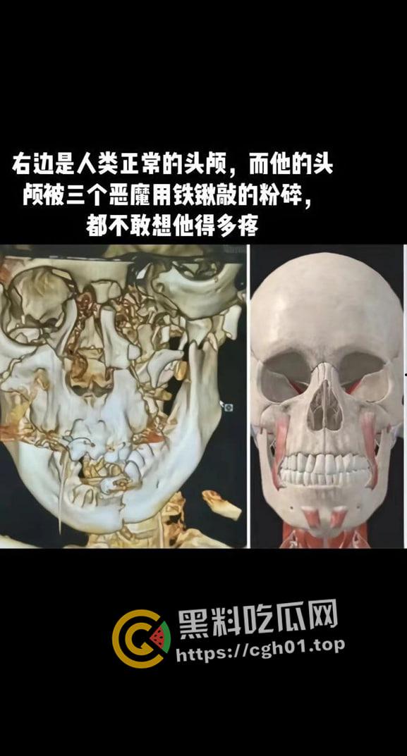河北邯郸【王子耀】案件后续！相关直播间被封 疑似有家长协助 死者脑部CT流出被打稀烂 疑点重重-1