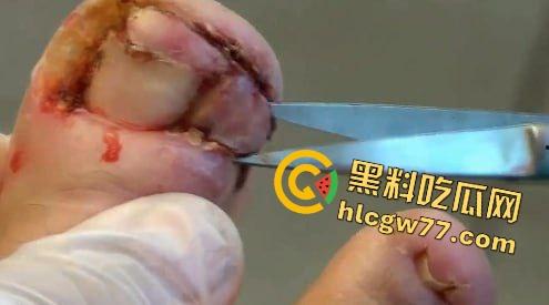 患者天天啃脚指甲狂得甲沟炎!帕尔米耶里手术刀下血肉狂飙,操刀医生差点呕吐!-2