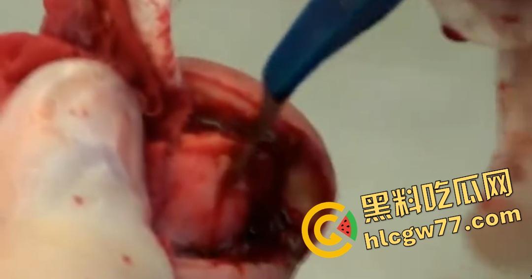 患者天天啃脚指甲狂得甲沟炎!帕尔米耶里手术刀下血肉狂飙,操刀医生差点呕吐!-6