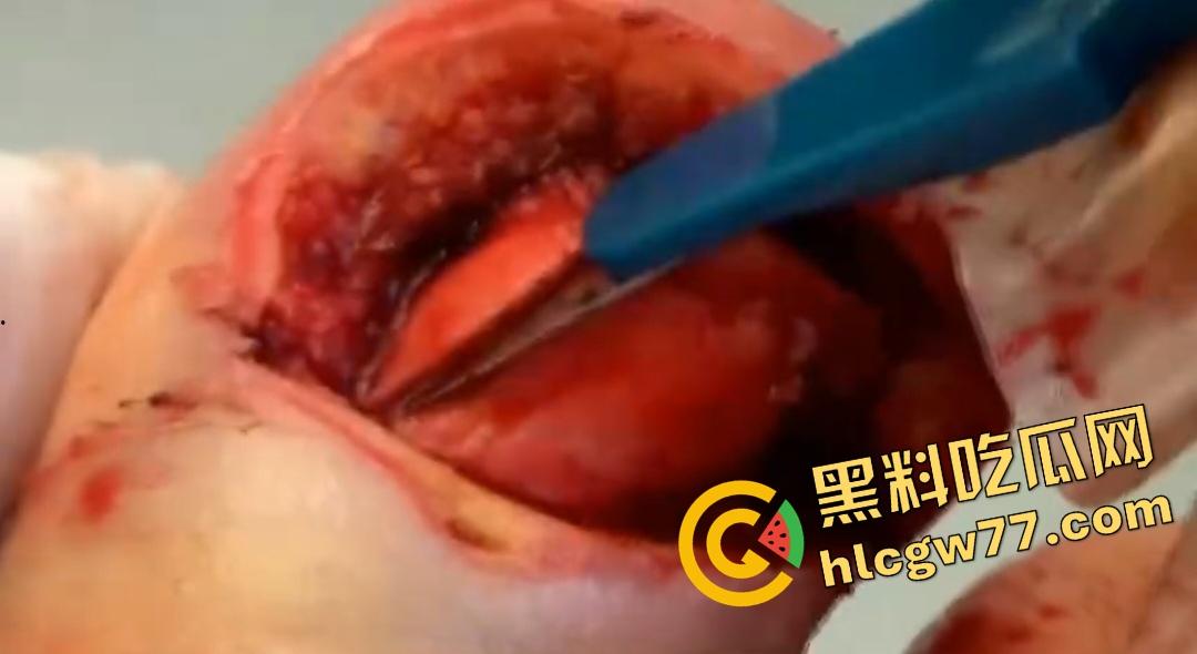 患者天天啃脚指甲狂得甲沟炎!帕尔米耶里手术刀下血肉狂飙,操刀医生差点呕吐!-7