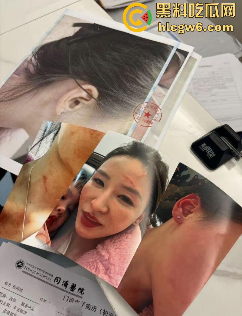 湖北一小学美女老师抖音自曝离婚探女遭前夫爹殴打抓脸全身多处受伤 伤情实拍曝光！都是血口子-1