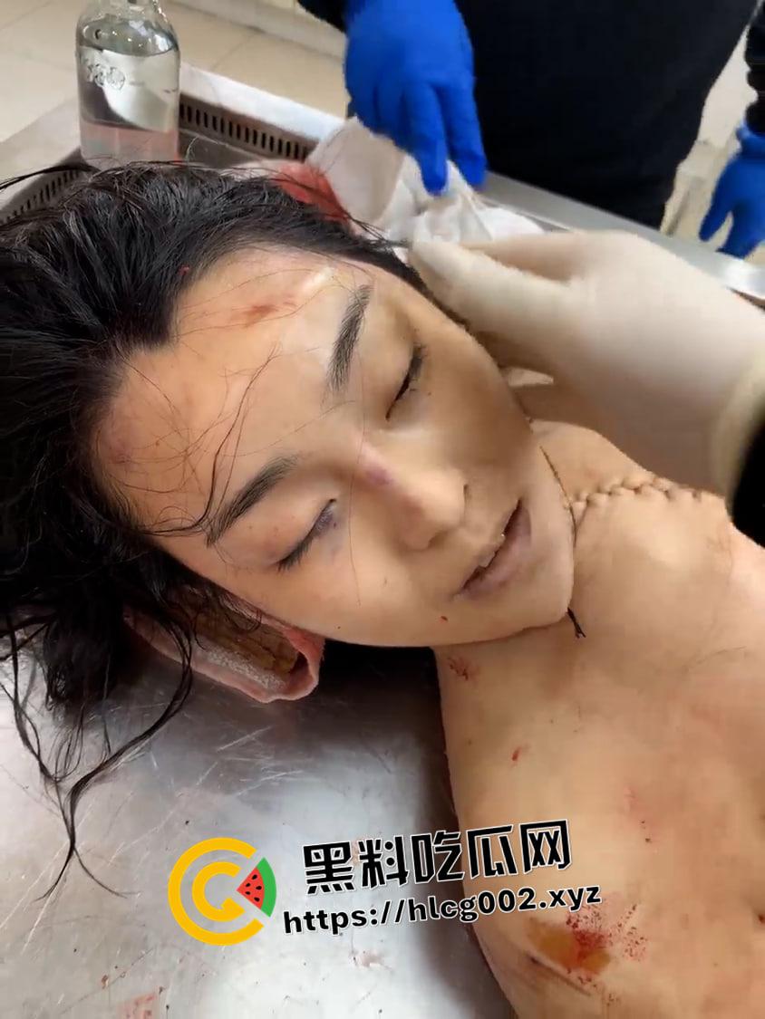 恐怖慎入！辽宁【徐园】案尸检现场视频流出 被前男友家暴致死打的面目全非-9