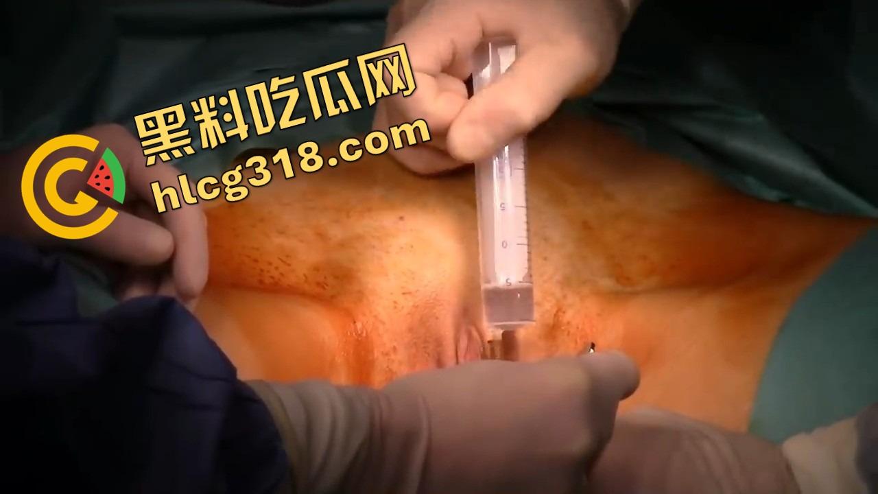 阴唇整形一刀逆天改命,黑木耳变粉鲍鱼,大阴唇手术直接打造一线天馒头逼,姑娘做完直接彩礼翻倍!-8