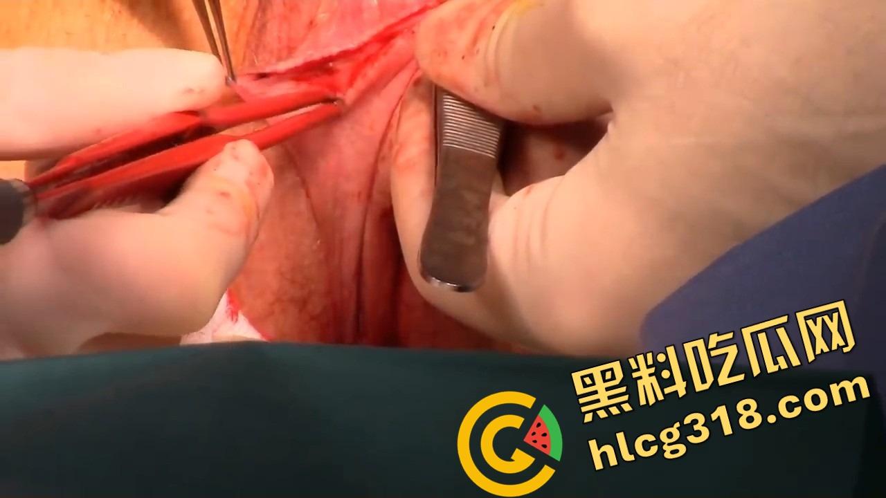 阴唇整形一刀逆天改命,黑木耳变粉鲍鱼,大阴唇手术直接打造一线天馒头逼,姑娘做完直接彩礼翻倍!-11